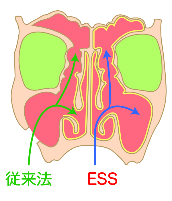 ESS（内視鏡下副鼻腔手術）