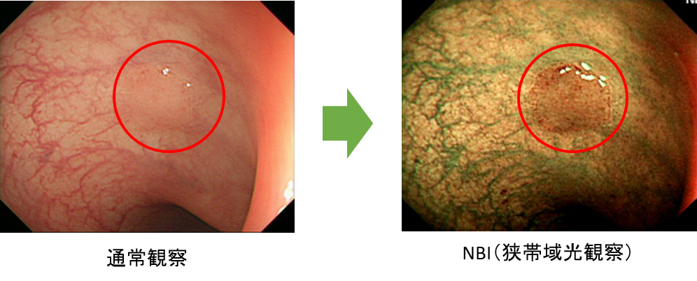 NBIによる高精度な内視鏡検査